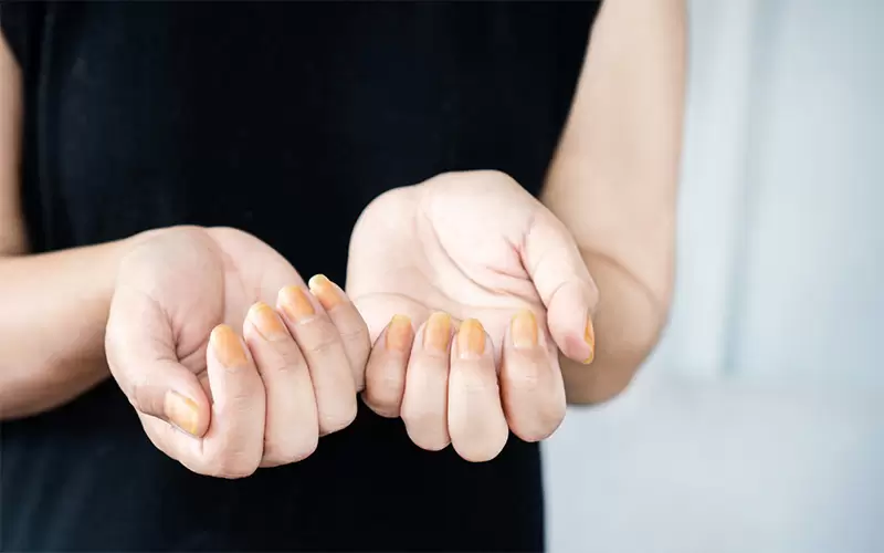 Woman showing yellow nail fungus caused by wearing nail polish